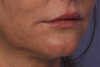 Perlane L to Lips