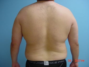 liposuction