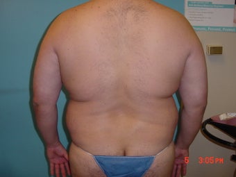 liposuction
