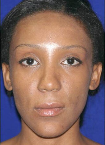 Ethnic Rhinoplasty