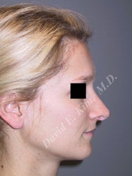 Rhinoplasty