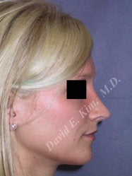 Rhinoplasty