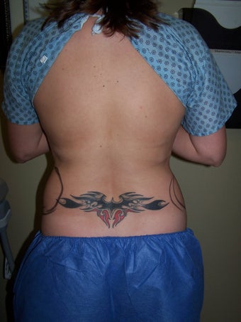 Vaser liposuction