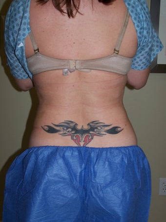 Vaser liposuction
