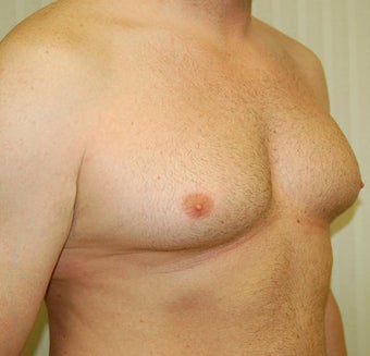 Male Breast Reduction
