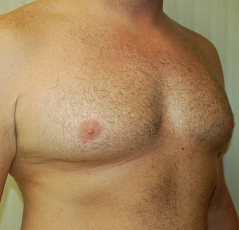 Male Breast Reduction