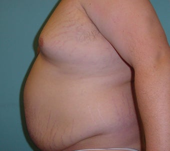 Male liposuction/liposculpture