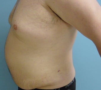 Male liposuction/liposculpture
