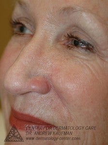 Mohs Surgery of Basal Cell Carcinoma and Recontruction