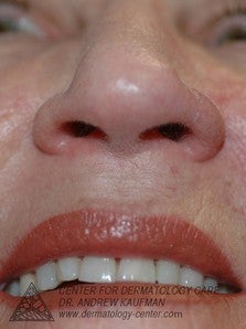 Mohs Surgery of Basal Cell Carcinoma and Recontruction