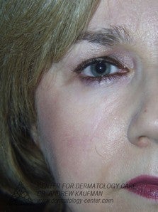 Mohs Surgery of Lentigo Maligna (Melanoma) and Reconstruction