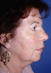 Facelift and Eyelid Surgery