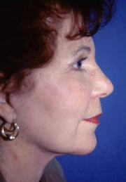 Facelift and Eyelid Surgery