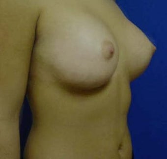 Transaxillary Breast Augmentation 