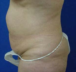 Abdomiplasty (Tummy Tuck)/Liposuction of abdomen, flanks and lateral chest areas