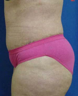 Abdomiplasty (Tummy Tuck)/Liposuction of abdomen, flanks and lateral chest areas