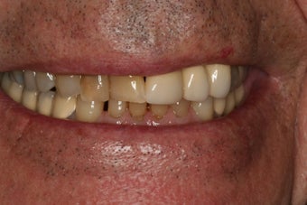 Full mouth reconstruction