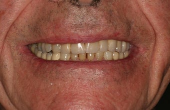 Full mouth reconstruction