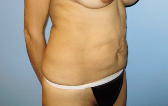 Abdominoplasty
