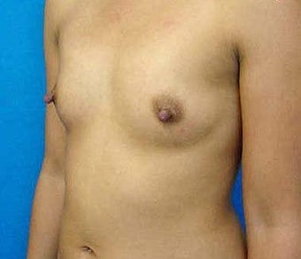 Breast Augmentation 