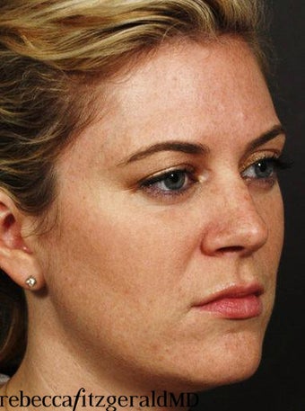 Sculptra /  IPL