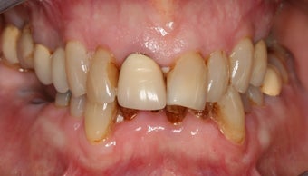 Smile makeover/full mouth reconstruction