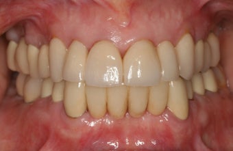 Smile makeover/full mouth reconstruction