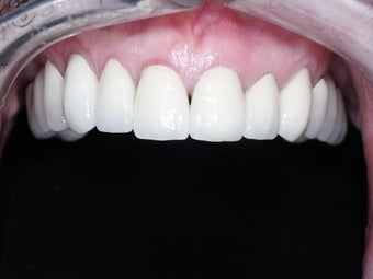 smile makeover