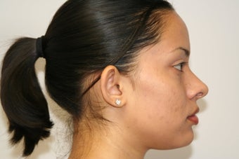 Otoplasty