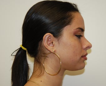 Otoplasty