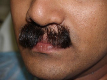 Facial Hair Transplant