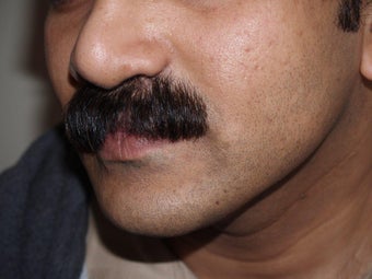 Facial Hair Transplant