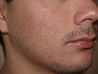Facial Hair Transplant