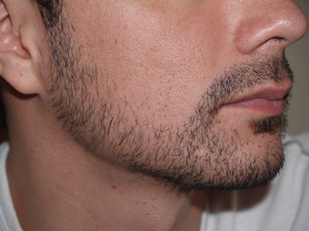 Facial Hair Transplant