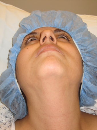 Rhinoplasty and Septoplasty