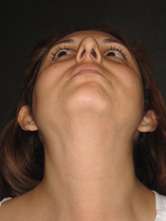 Rhinoplasty and Septoplasty