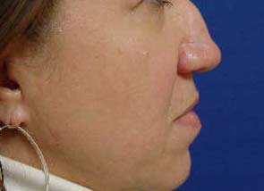 Rhinoplasty