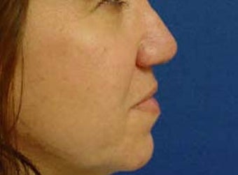 Rhinoplasty
