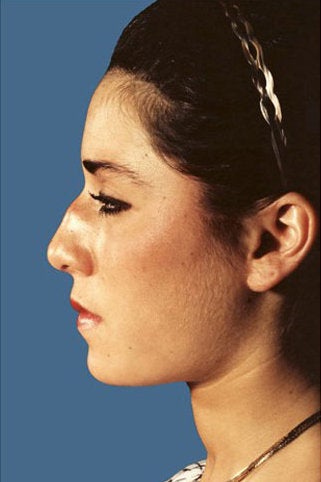 Rhinoplasty