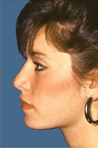 Rhinoplasty