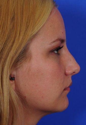 Revision Rhinoplasty