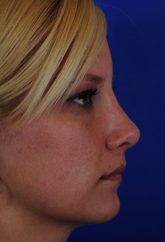 Revision Rhinoplasty