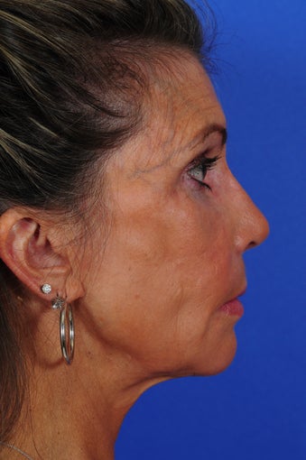 Revision Rhinoplasty