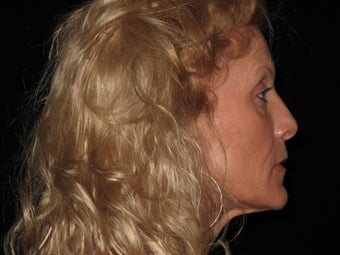 Botox and Restylane