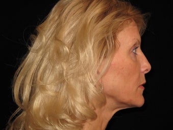 Botox and Restylane