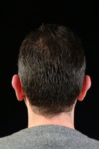Ear Pinning