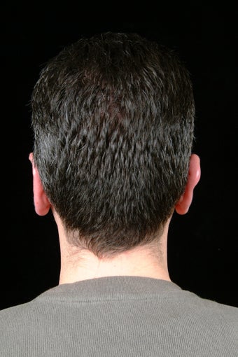 Ear Pinning