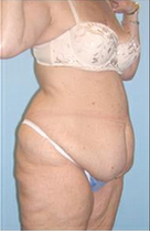 Body Lift