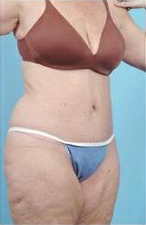 Body Lift