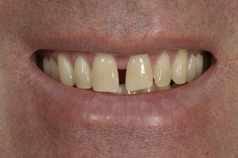 Closing a space between the front teeth with dental bonding